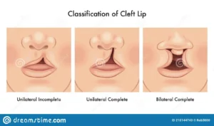 Cleft Lips And Cleft Palate