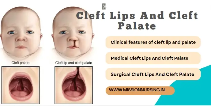 Cleft Lips And Cleft Palate -hare lip