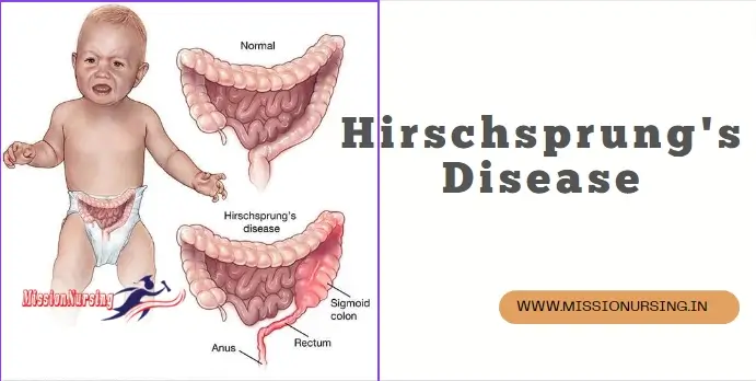 hirschsprung's Disease- Types, treatment, Nursing Care