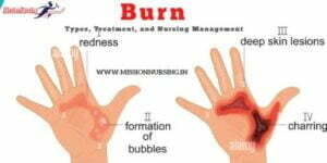 Burn: Types, Treatment, and Nursing Management