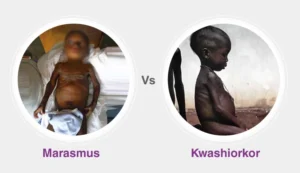 Difference between Marasmus and Kwashiorkor