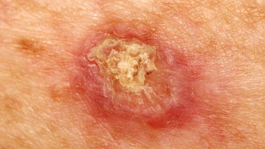 Skin Cancer Couse Type Treatment Nursing Management   Skin Cancer Couse Type Treatment 1024x575 