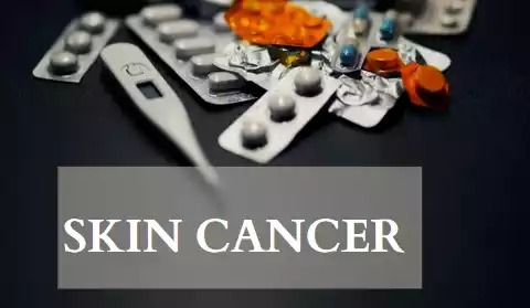 Skin Cancer: Couse, Type, Treatment & Nursing Management